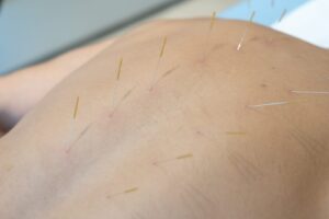 Fine dry needling needles in the upper back and shoulder muscles at KINETIKA Dubai Hills